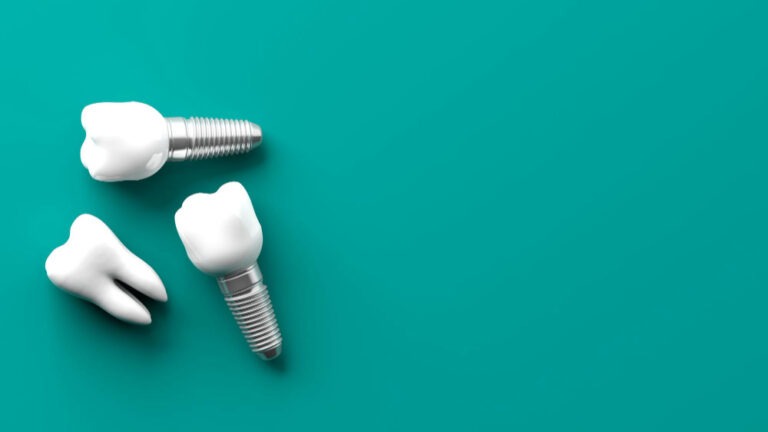 FAQ impianto dentale a Torino